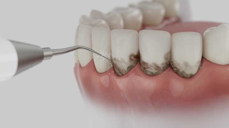 Trusted Wisdom Tooth Removal service in Squaw Valley, CA - Dentist Open Now
